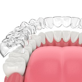 Treatment with Invisalign is less invasive than traditional braces