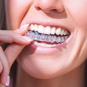 Invisalign aligners are more comfortable than traditional braces