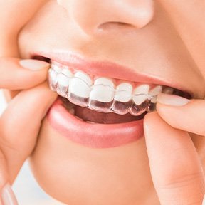 Closeup of woman putting Invisalign over her teeth