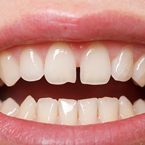 Invisalign can help close gaps in between teeth