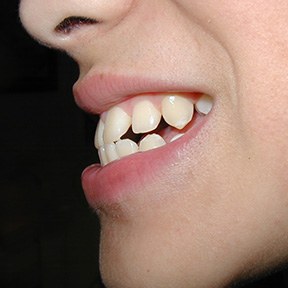 Overbite is a common issue that can be corrected by Invisalign