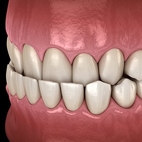 Invisalign can help treat an underbite and protect your teeth