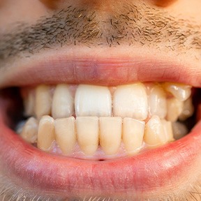 Invisalign can treat crossbites