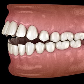 Invisalign is an effective treatment for some cases of open bite