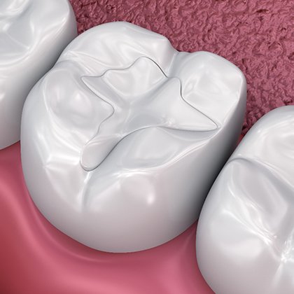 A 3D illustration of tooth-colored fillings