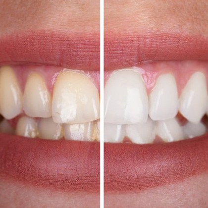 Side-by-side of stained and whitened teeth 