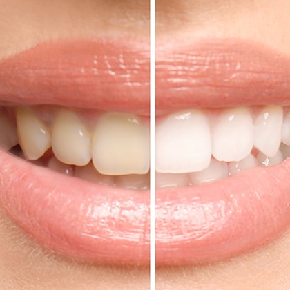 Closeup of a smile that’s halved to show before/after whitening